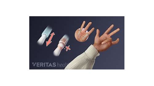 判断是否腱鞘炎的手势：了解症状，保护手腕